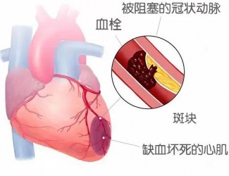 血栓的形成原因及后果，如何預(yù)防血栓導(dǎo)致的疾病